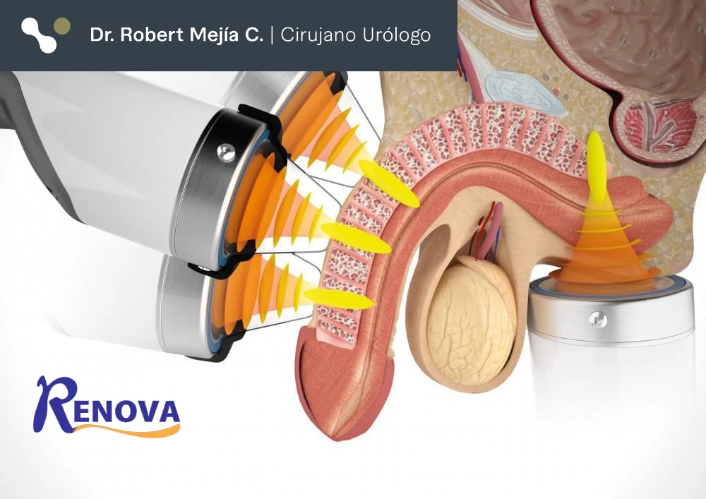 Renova, disfunción eréctil, disfuncion erectil | Dr. Robert Mejía, cirujano urólogo, Santo Domingo