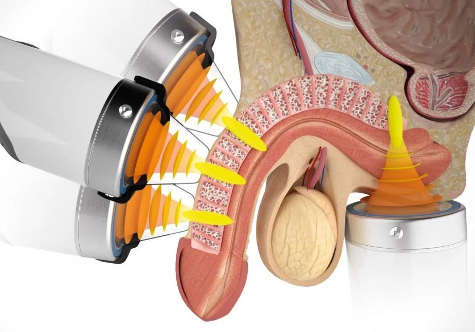 Renova, disfunción eréctil, renova disfucion erectil, disfuncion erectil | Dr. Robert Mejía, cirujano urólogo, Santo Domingo, renova santo domingo, renova rd